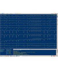 Компьютерный электрокардиограф «МИОКАРД-12»