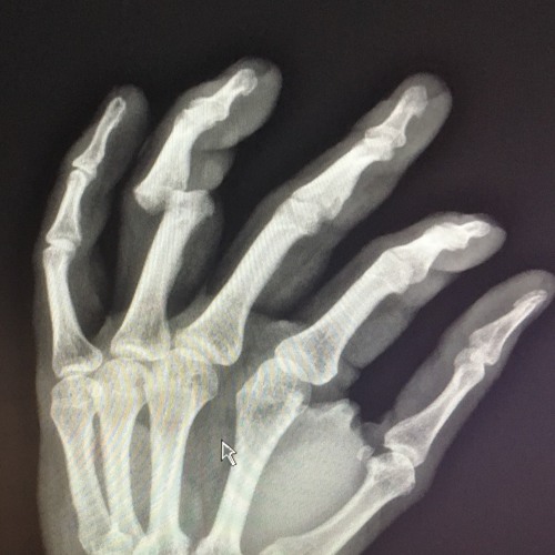 Переломы пальцев рук у детей - симптомы, признаки и лечение в «СМ-Клиника» для детей и подростков